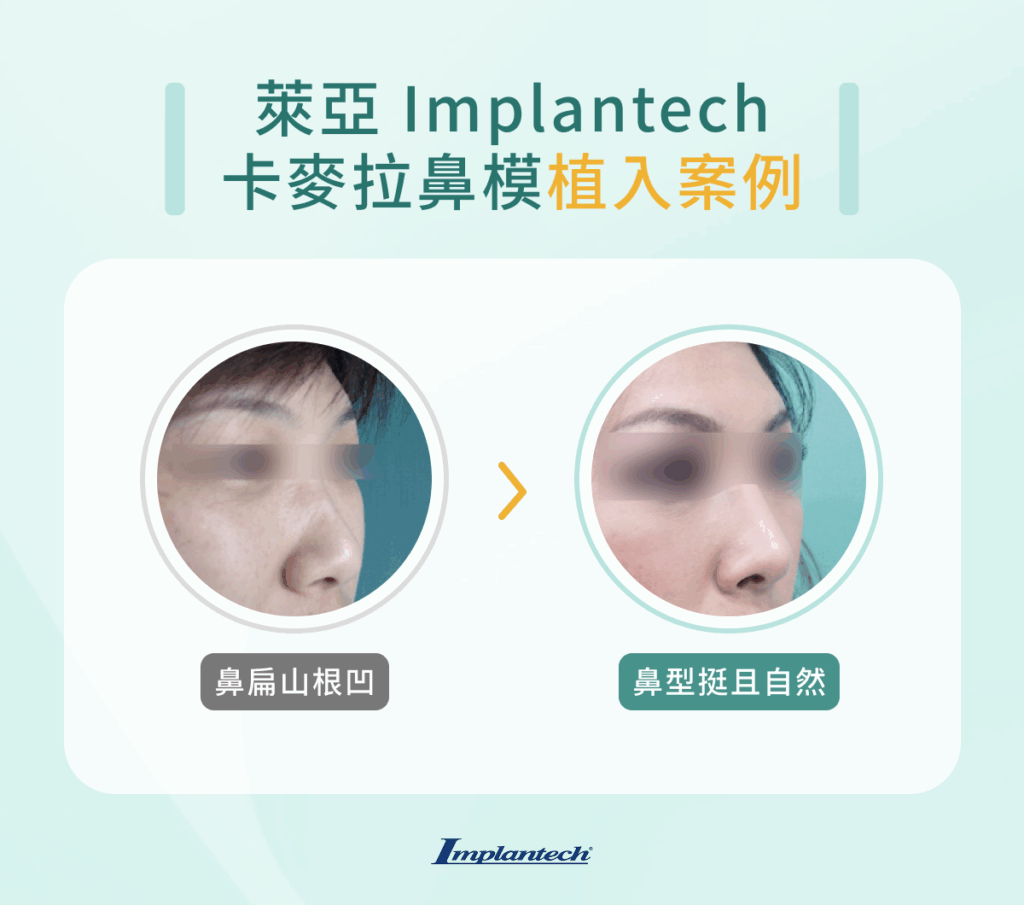 萊亞 Implantech 卡麥拉鼻模植入案例